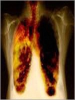 Это рентгеновский снимок лёгких курильщика, уже больного раком…