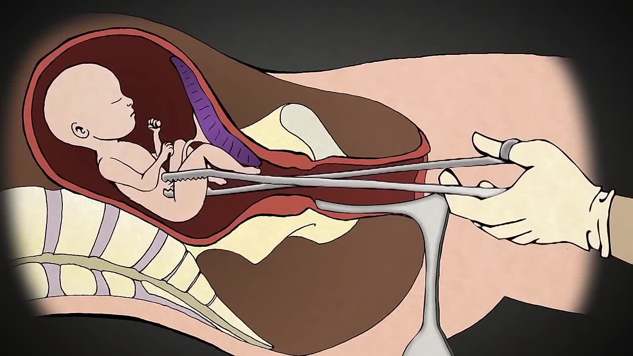 Операция искусственного аборта